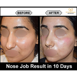 rhinoplasty-img7